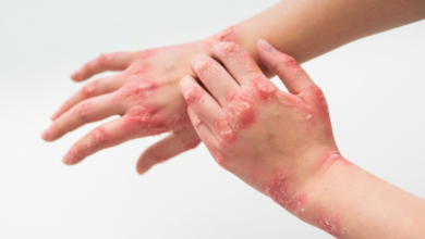 How Diagnostic Labs Help Detect and Manage Fungal Infections