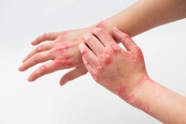 How Diagnostic Labs Help Detect and Manage Fungal Infections